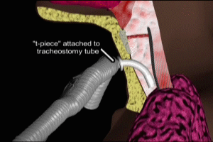 Tracheostomy