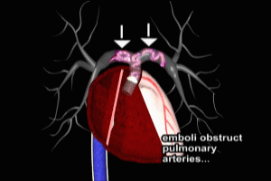 Saddle Pulmonary Embolism