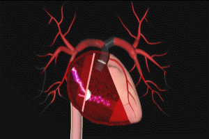 Pulmonary Embolism