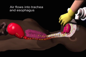 Neonatal Endotracheal Intubation