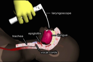 Endotracheal Intubation