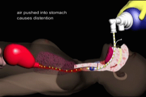 Esophageal Intubation