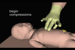 Chest Compressions Neonatal