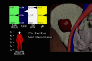 Hemorrhagic Shock