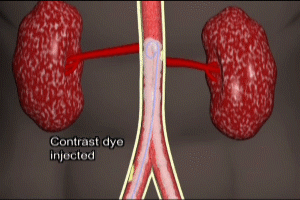 Angiogram of the Abdominal Aorta