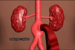 Abdominal Aortic Aneurysm