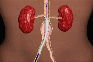 Endovascular Graft for Abdominal Aortic Aneurysm