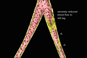 Abdominal Aortic Aneurysm and Iliac Artery Stenosis