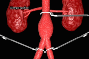 Tube Graft for Abdominal Aortic Aneurysm