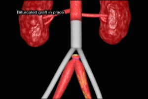 Bifurcated Graft for Abdominal Aortic Aneurysm