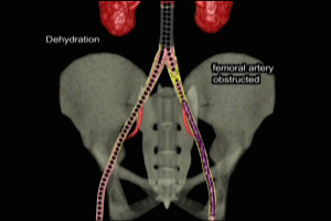 Tube Graft Thrombosis