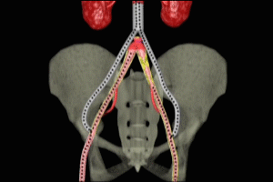 Dehydration and Bifurcated Graft for AAA