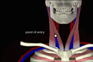 Internal Jugular Vein Access in Normovolemic Patient