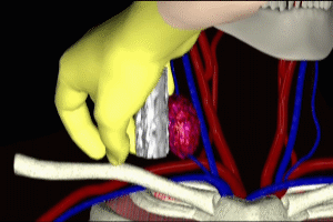 Internal Jugular Vein Access