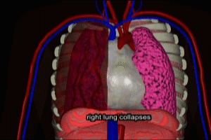 Subclavian Vein Access in Hypovolemic Patient