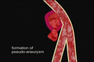 Pseudoaneurysm