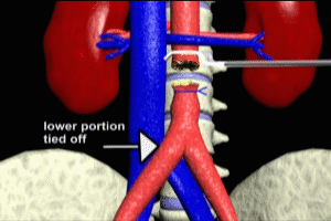 Aortofemoral Bypass Graft