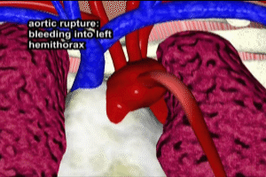 Hemothorax in Aortic Dissection