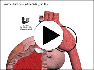 Aortic Aneurysm