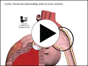 Aortic Aneurysm (cross-section)