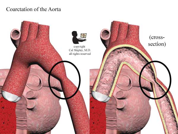 Aortic Coarctation