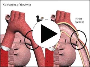 Coarctation of the Aorta