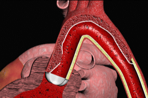 aortic dissection