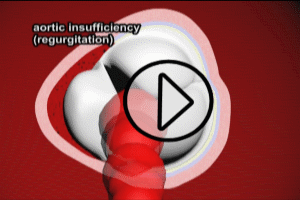 Aortic Insufficiency due to Aortic DIssection