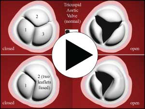 Bicuspid Aortic Valve