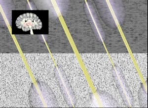 diffuse axonal injury mechanism