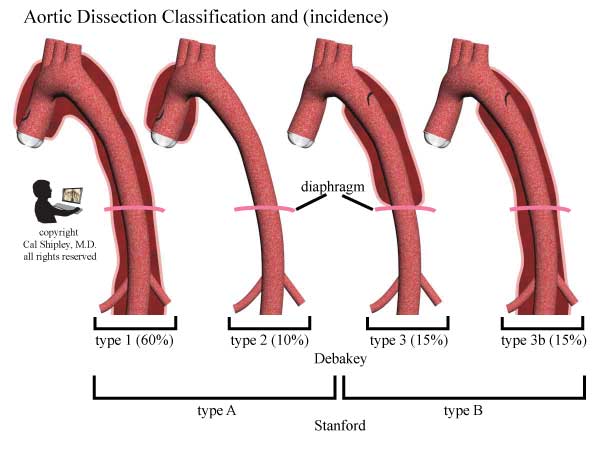 Aortic DIssection Classification