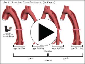 aortic dissection cross section