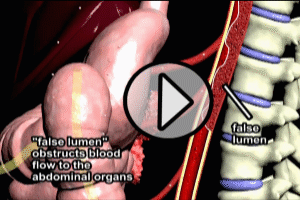 Aortic Dissection Blood FLow Obstruction