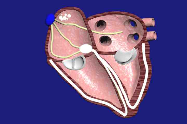 ectopic atrial tachycardia