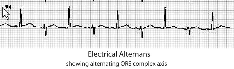 Electrical Alternans in Cardiac Tamponade