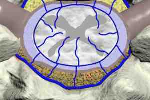 epidural infection