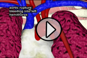 Hemothorax