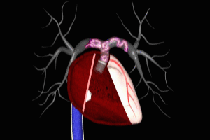 Saddle Pulmonary Embolism