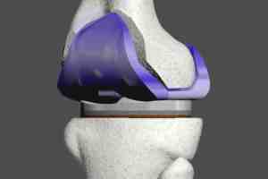 knee prosthesis