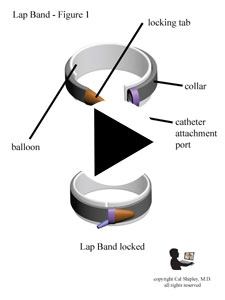 Lap Band Design for Bariatric Procedure
