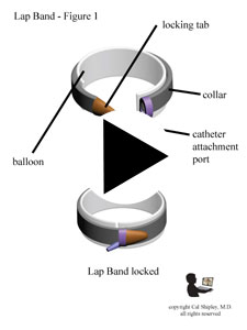 Lap Band Design