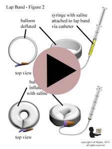 Lap Band Inflation
