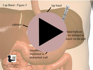 Lap Band Inflation Port