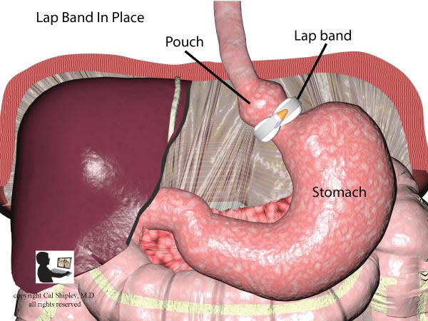 Lap Band Placement Bariatric Procedure