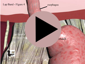 Lap Band Placement 1