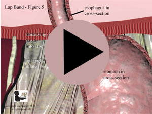 Lap Band Placement Cross Section