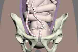 occult umbilical cord prolapse