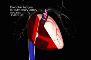 Pulmonary Embolism