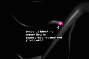 Recanalization in Pulmonary Embolism