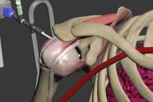 rotator cuff repair